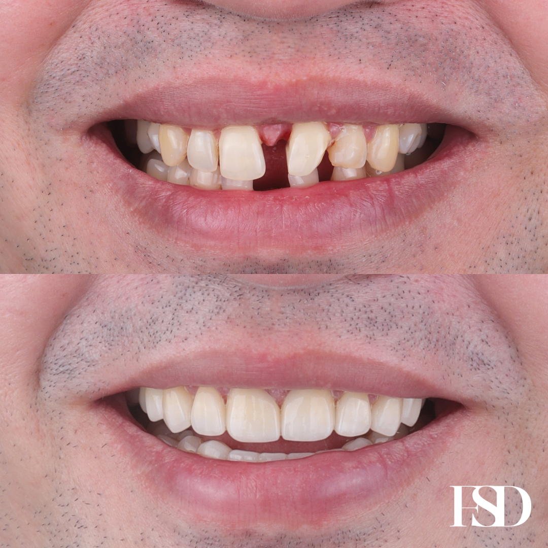 IntraOral