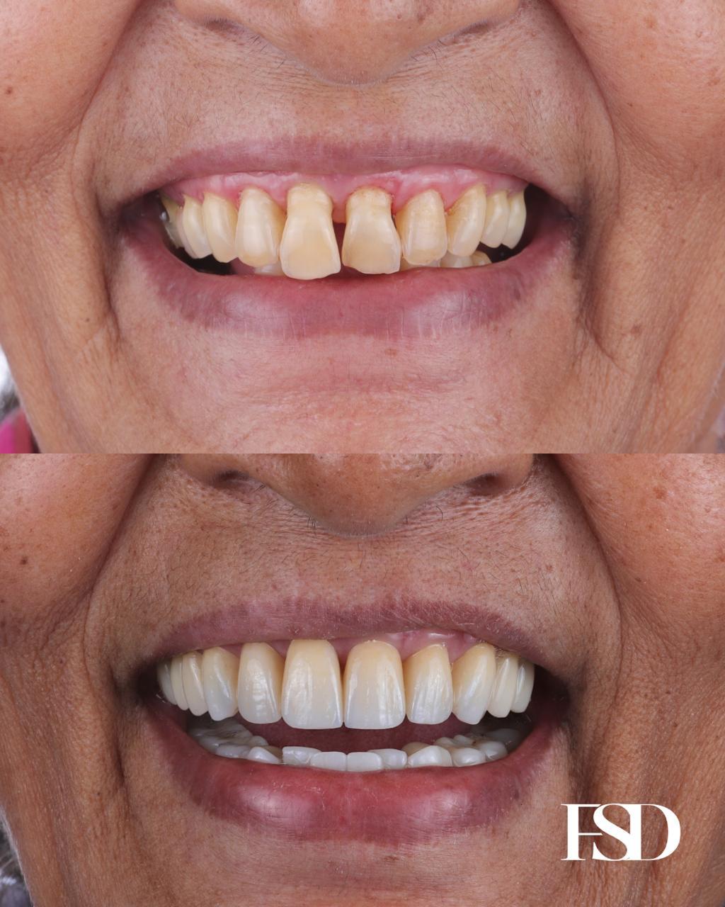 IntraOral