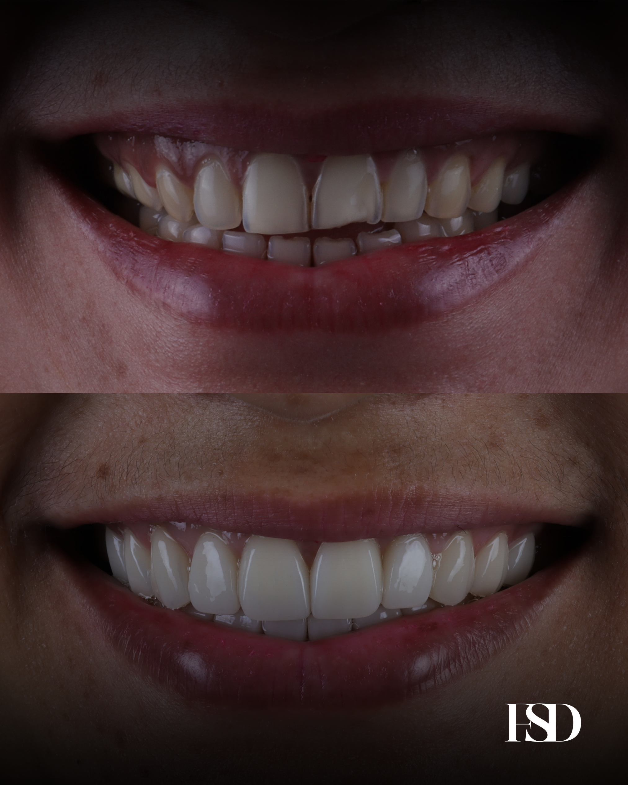 IntraOral