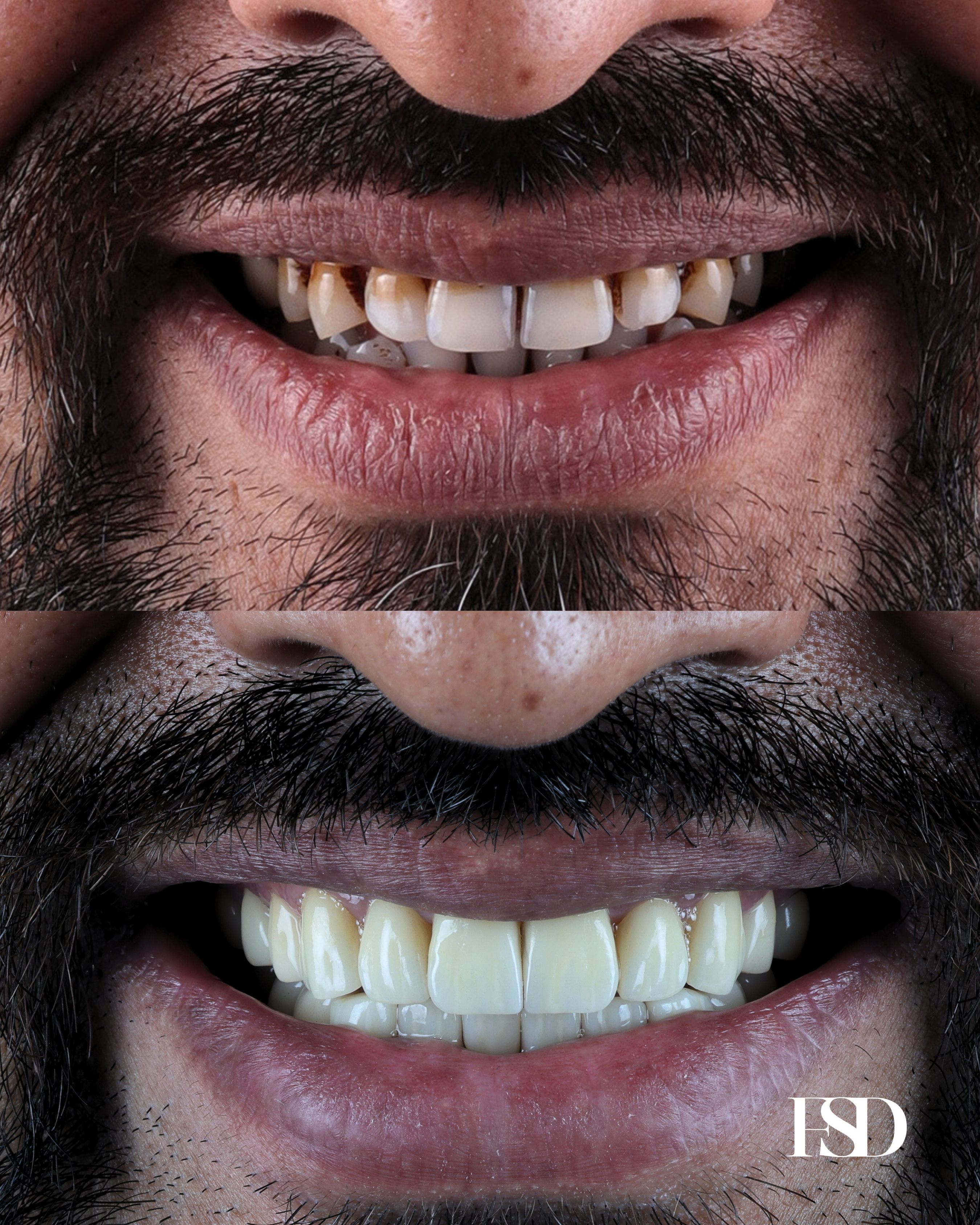IntraOral