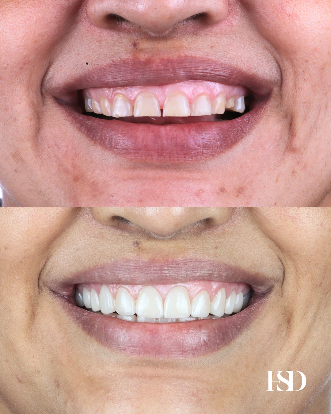 IntraOral