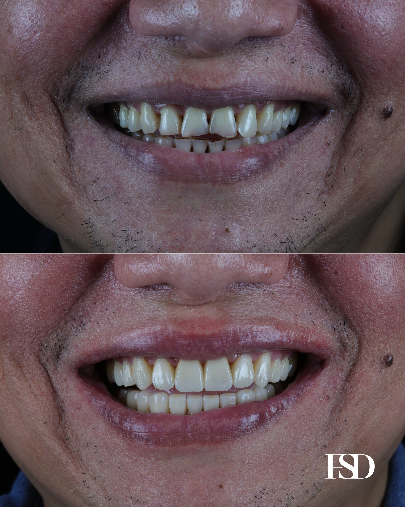 IntraOral