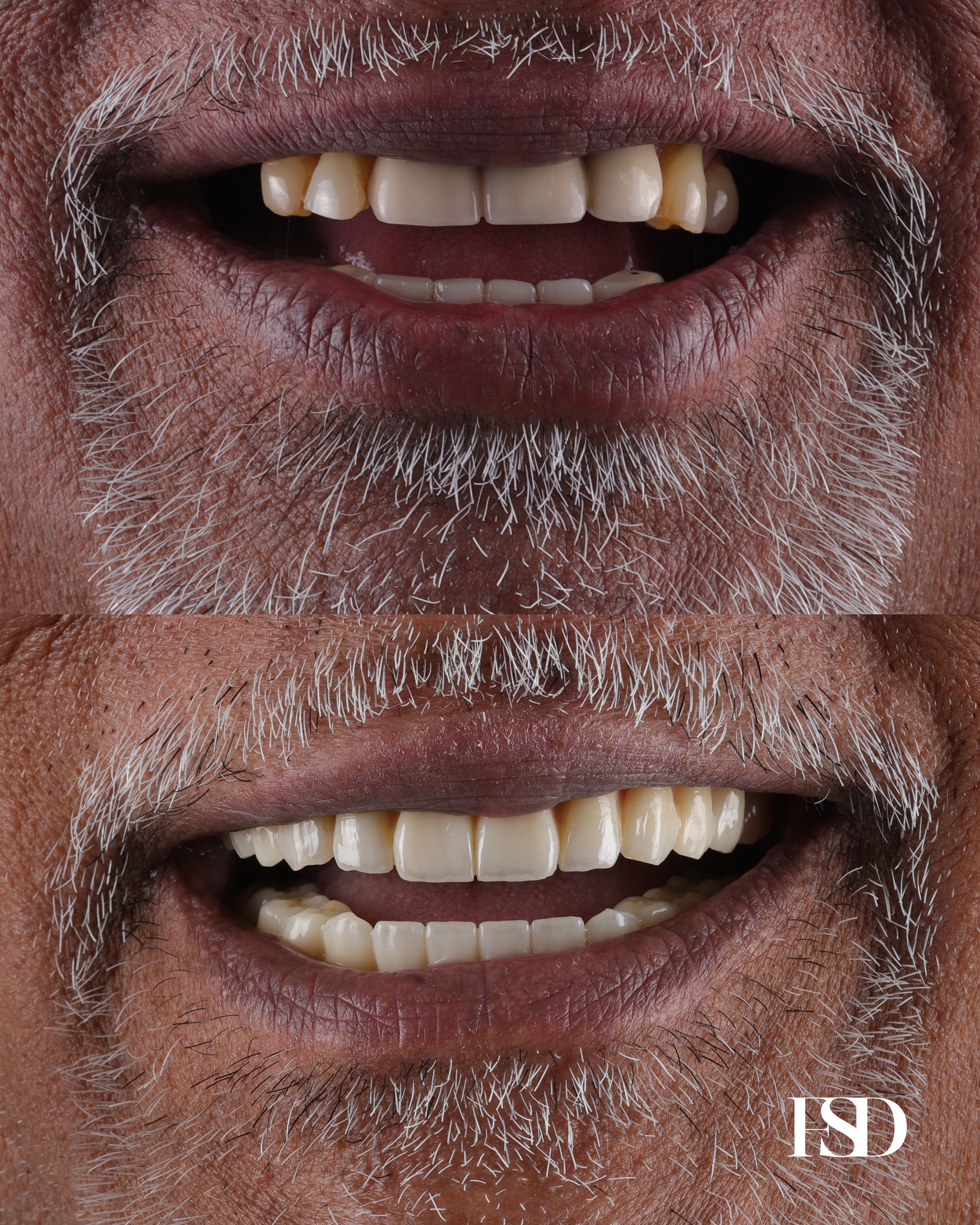 IntraOral