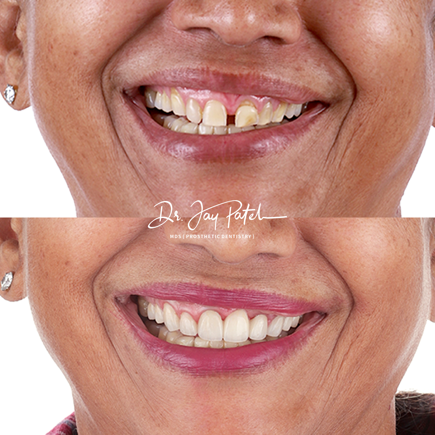 IntraOral