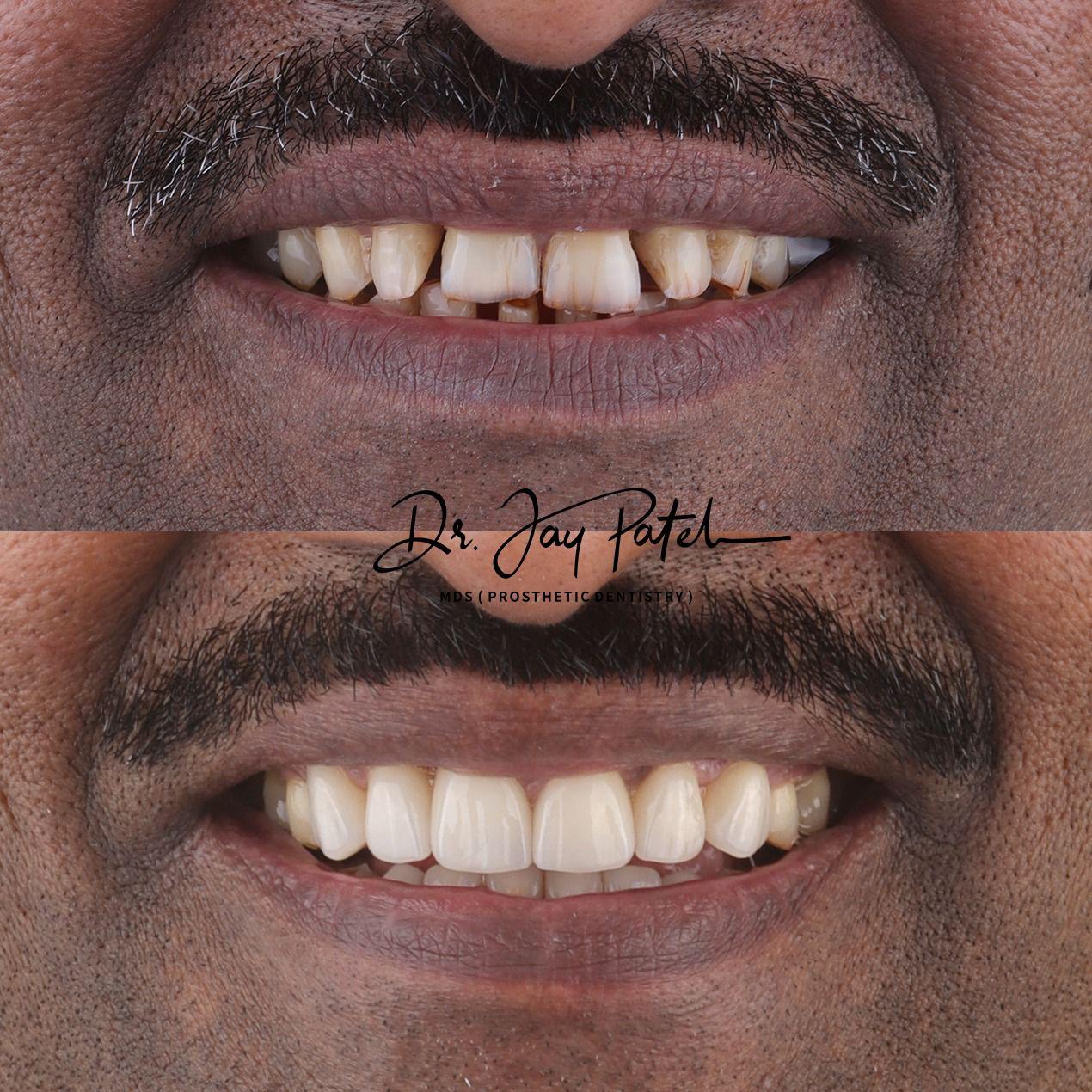 IntraOral