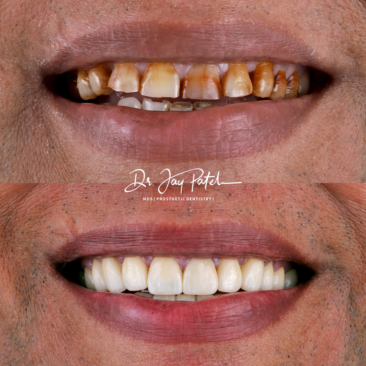 IntraOral