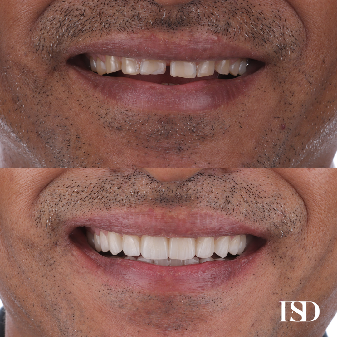 IntraOral