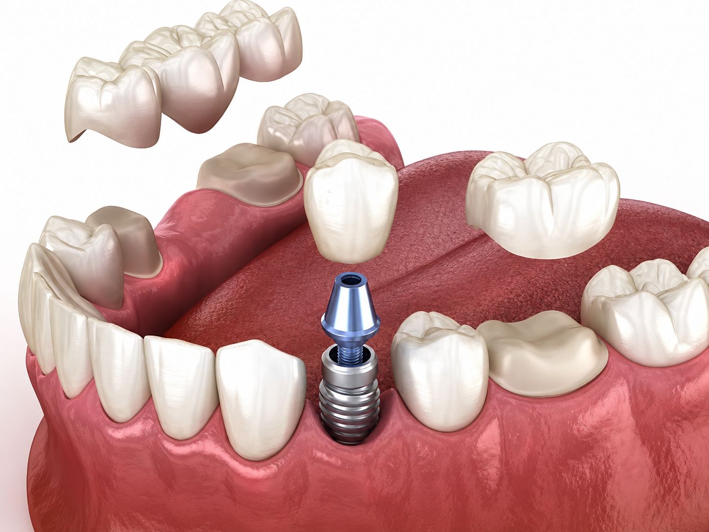 Dental Crowns and Bridges at Four Seasons Dental Surat