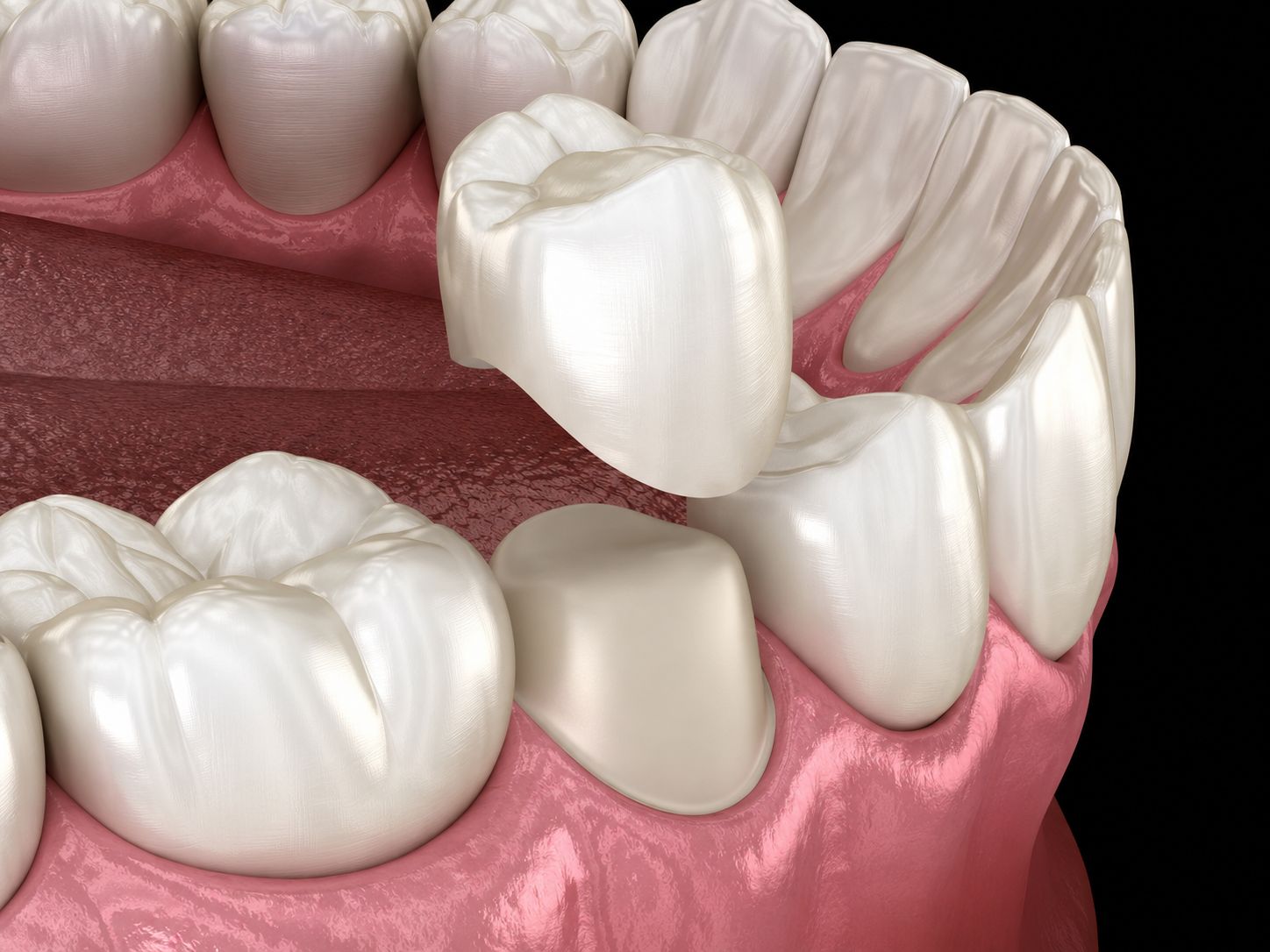 Dental Crown and Bridge