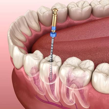 Root Canal Treatment Painless RCT at Four Seasons Dental Surat