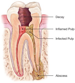 What is a Root Canal