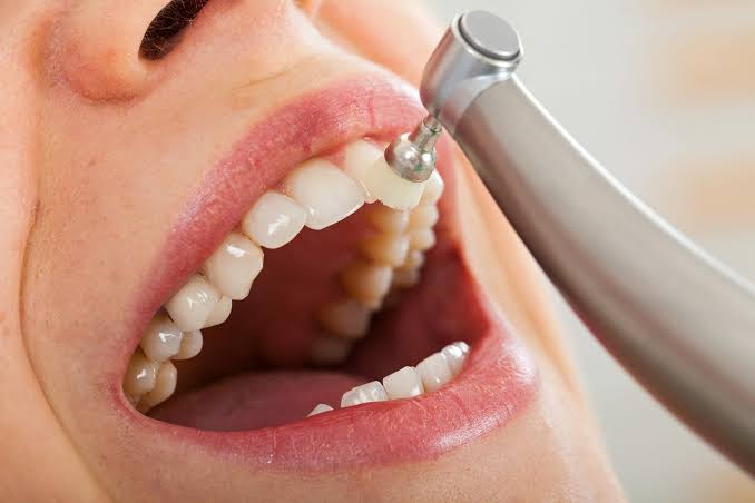 Professional teeth cleaning at Four Seasons Dental Surat